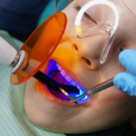 child getting dental sealants