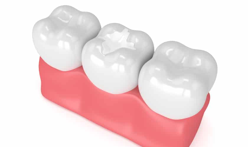 Dental Sealants in Rowlett Part 1: Clearing Up 5 Misconceptions