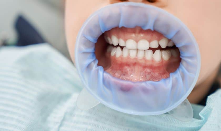 Should You Visit A Dental Office for Your Teeth Whitening?