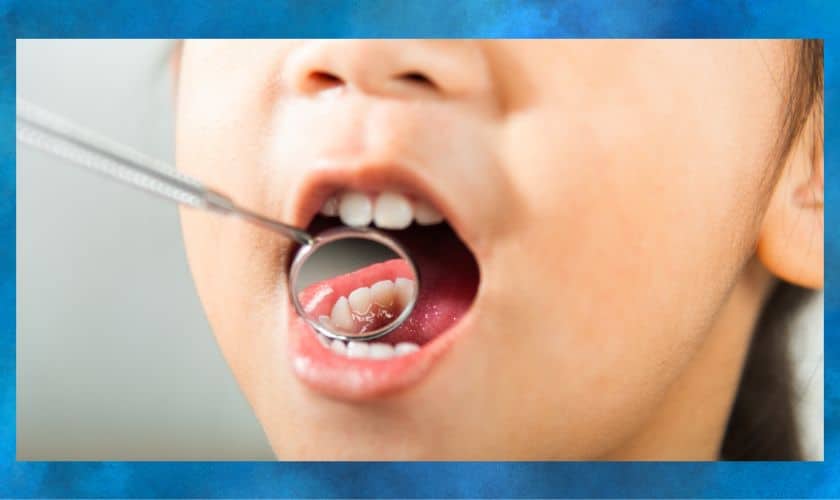 5 Proven Ways to Prevent Tooth Decay