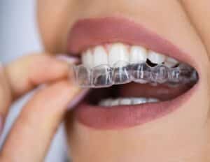 Clear aligners in rowlett tx