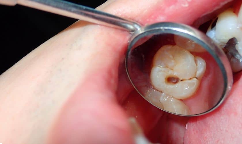 5 Essential Strategies to Safeguard Your Child’s Smile: Preventing Cavities with Ease