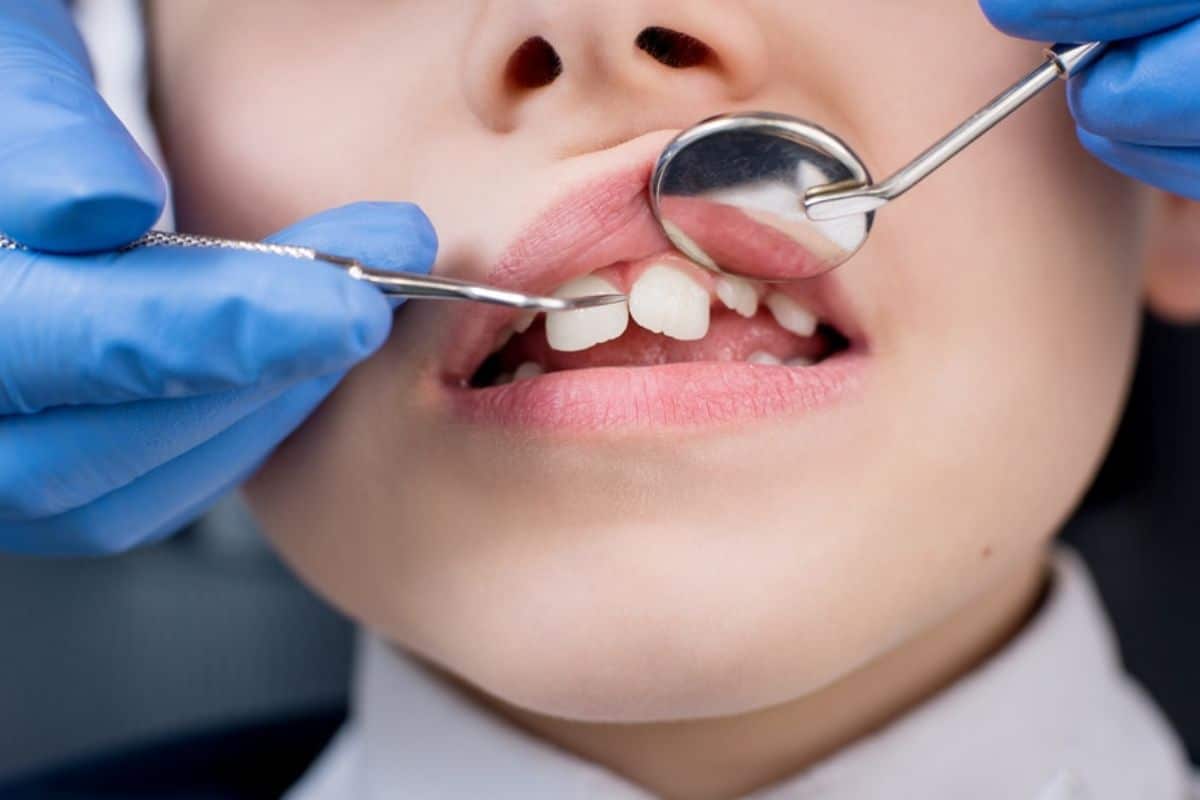 Understanding Buck Teeth in Kids: Causes and Treatment Options