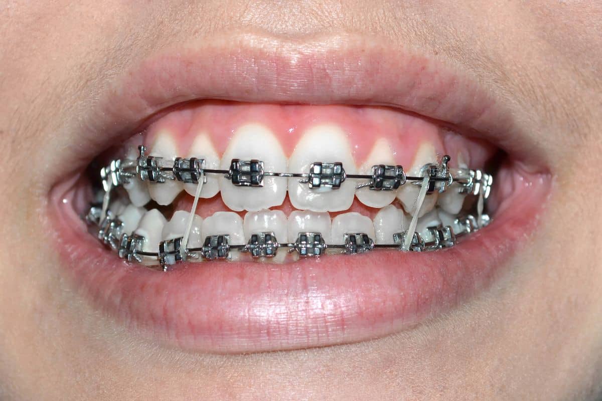 What to Do If a Braces Band Falls Off?