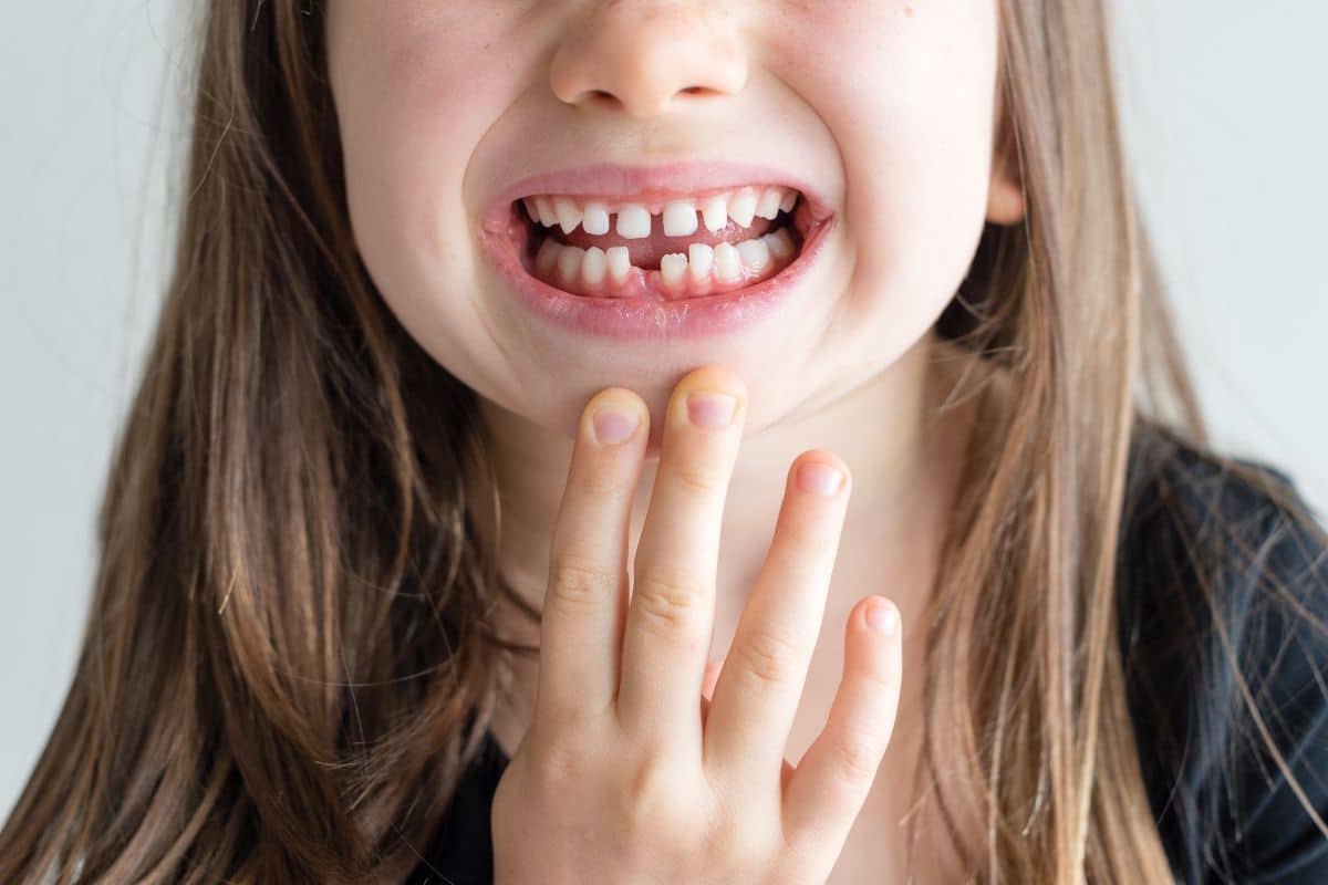 When Do Children Typically Lose Their Baby Teeth?
