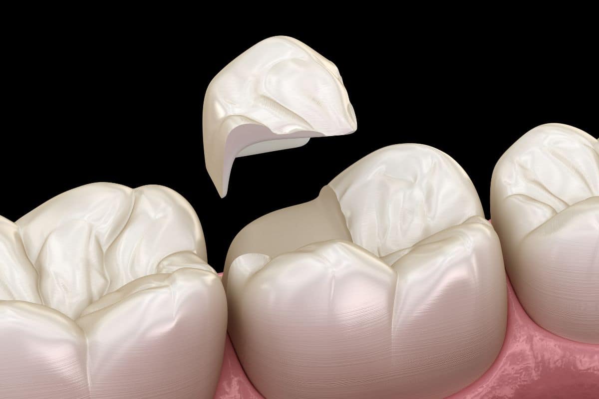 Are Dental Sealants Safe for Children?