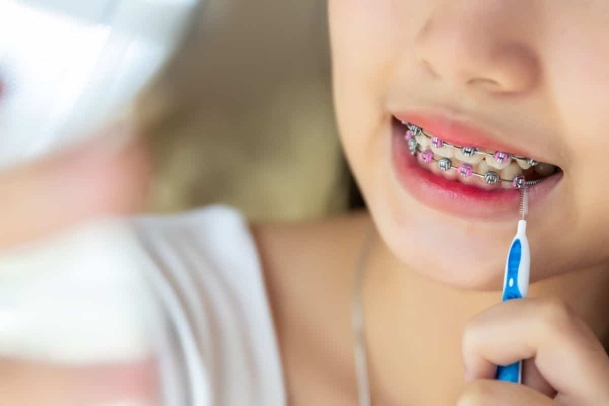 How Can I Maintain Oral Health While Wearing Braces?