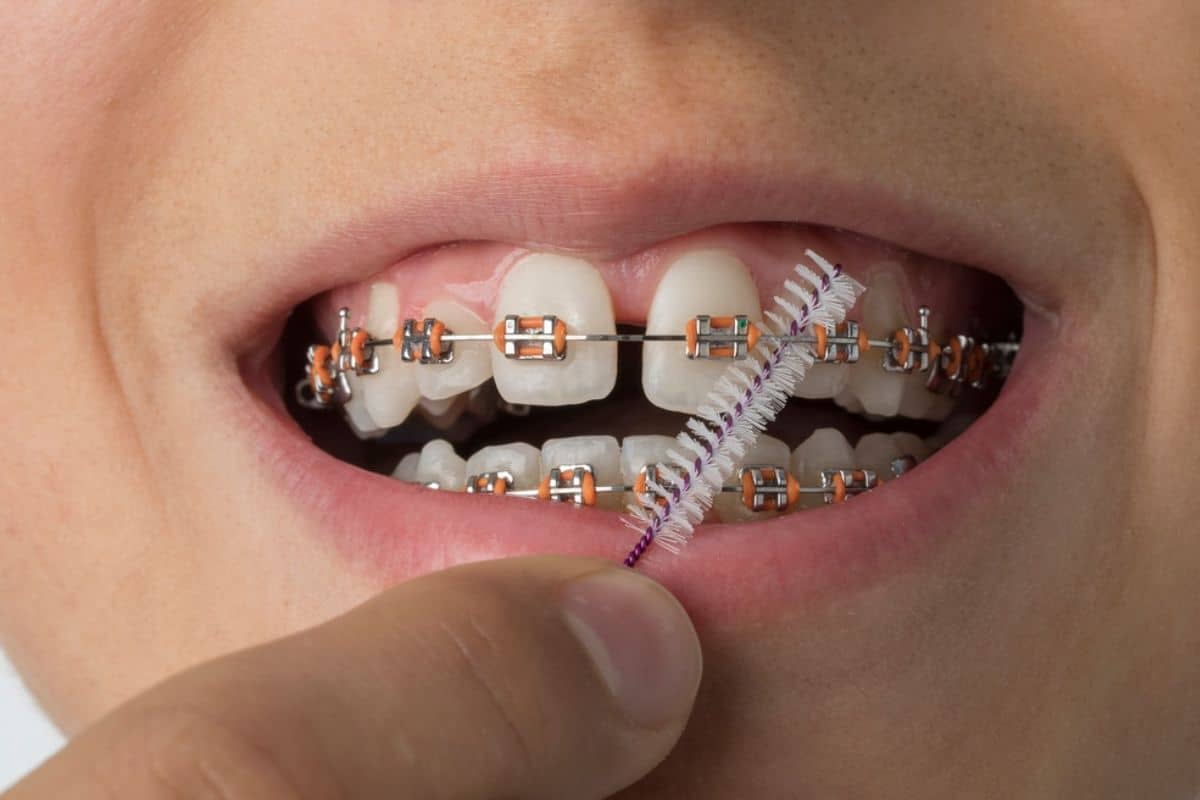 What Should You Do If Your Child Swallows a Braces Wire?