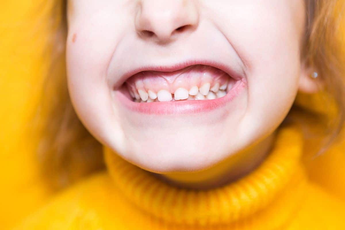 What Are Overjet and Overbite Differences?
