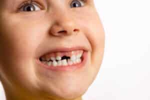 Dental Fillings Necessary for Baby Teeth