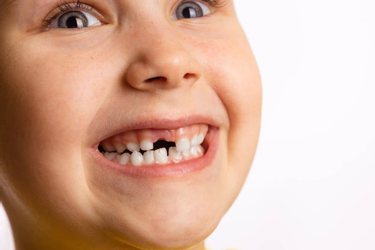 Why Are Dental Fillings Necessary for Baby Teeth?