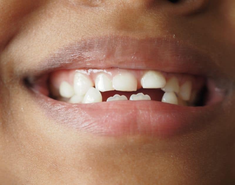 Can an Orthodontist Correct My Child’s Malocclusion?