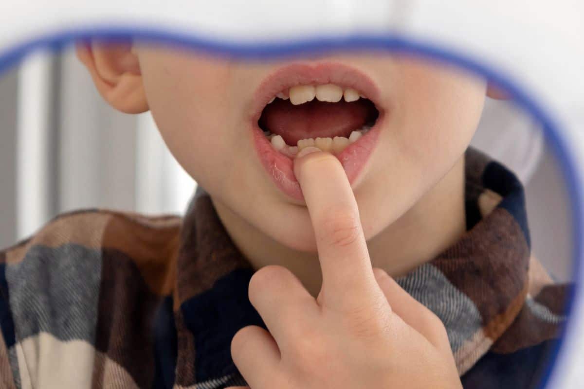 What Causes Tooth Holes in Kids and How Can They Be Treated?