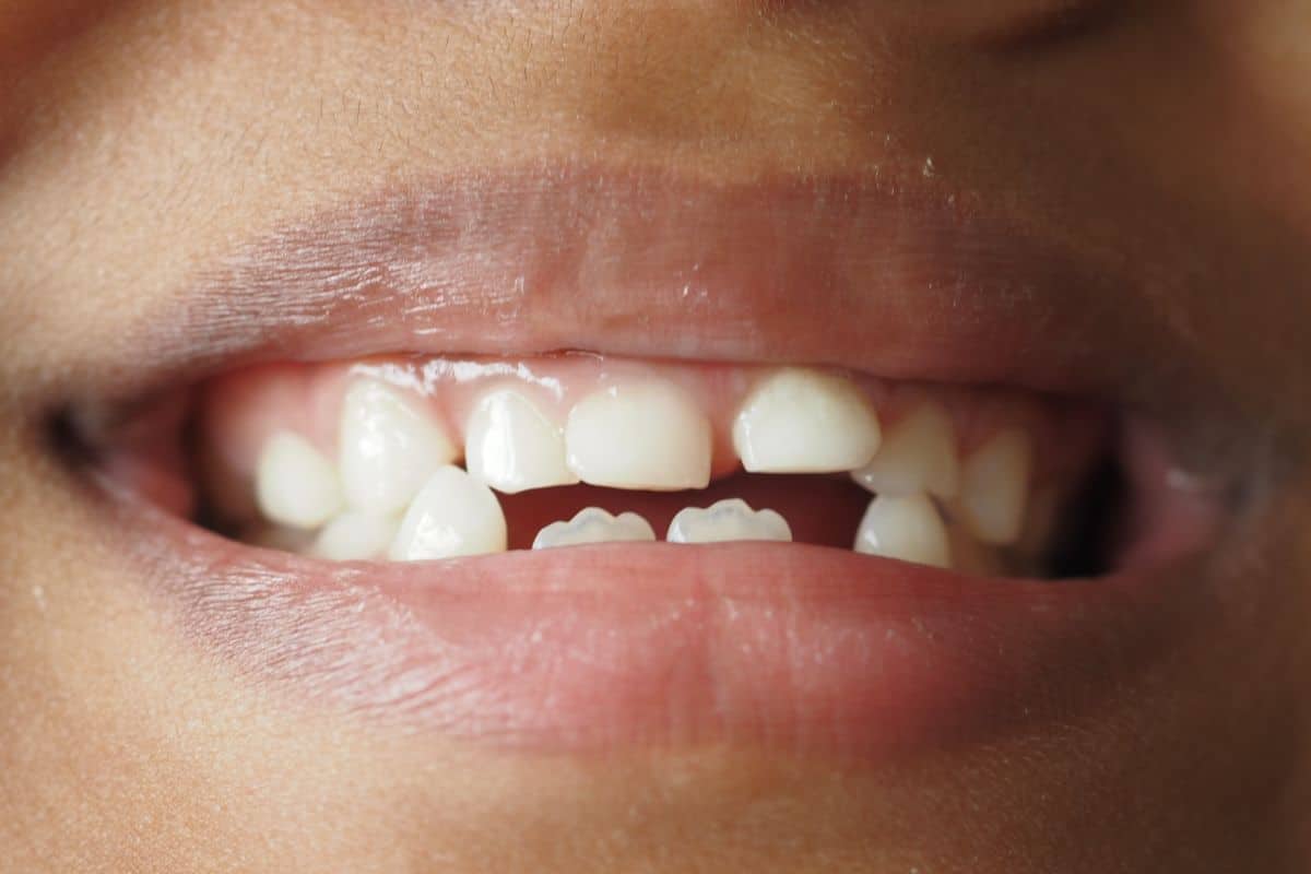What Causes Early Childhood Caries and How to Avoid It?