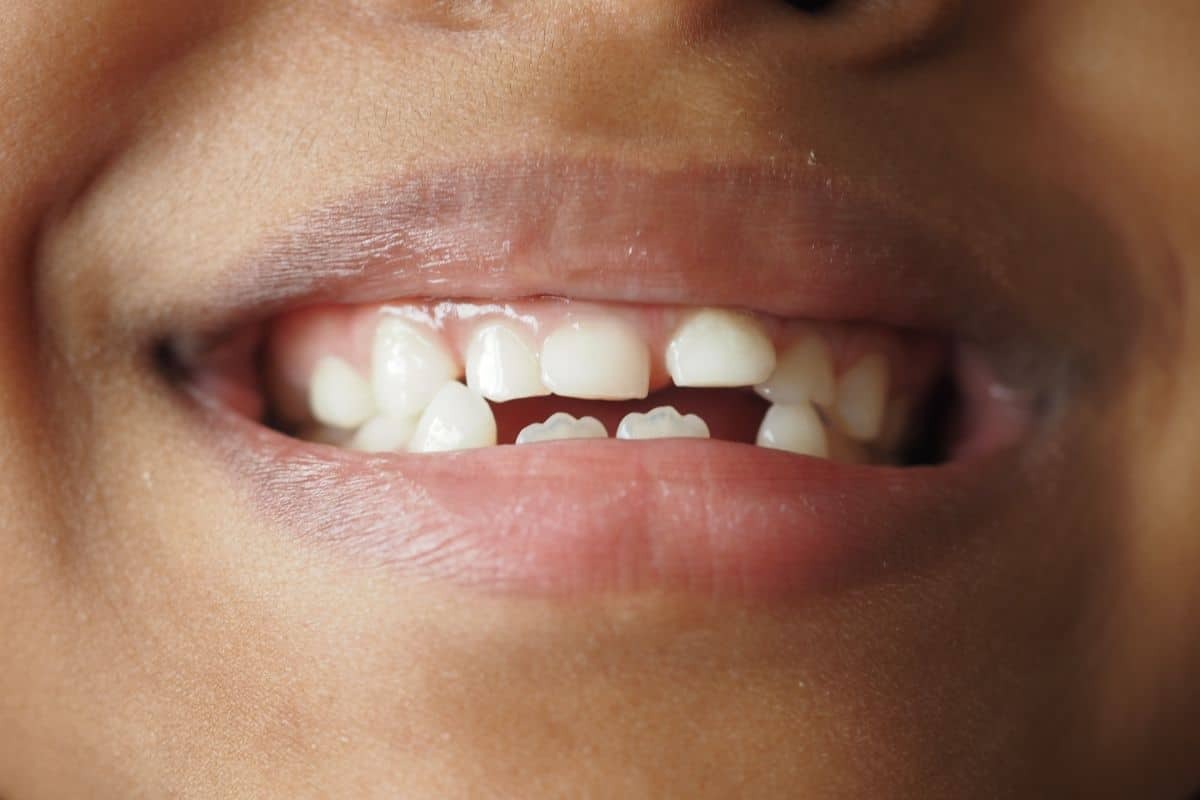 How to Handle Your Child’s Chipped Tooth Effectively?