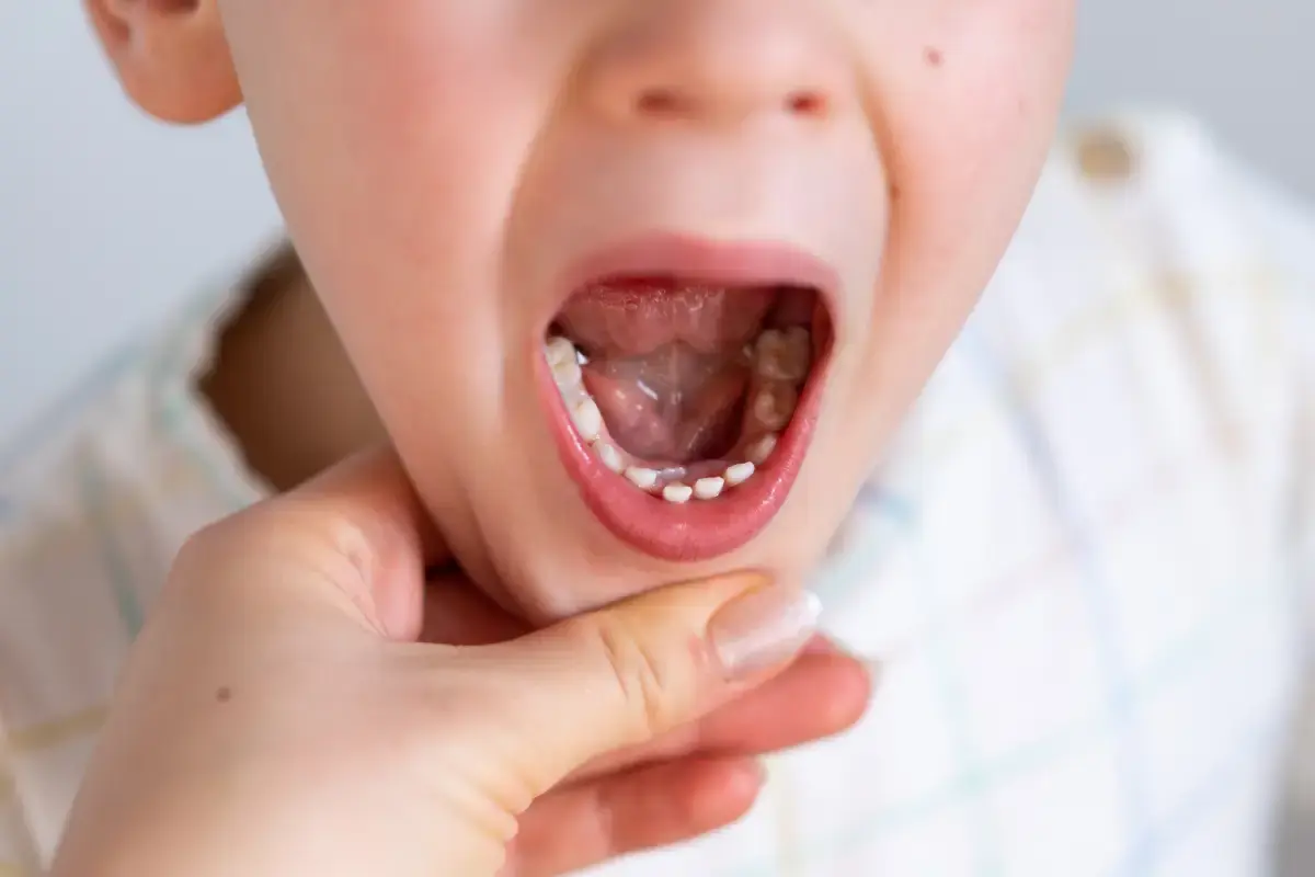 Why Has My Child Lost a Baby Tooth but the Adult Tooth Hasn’t Appeared?