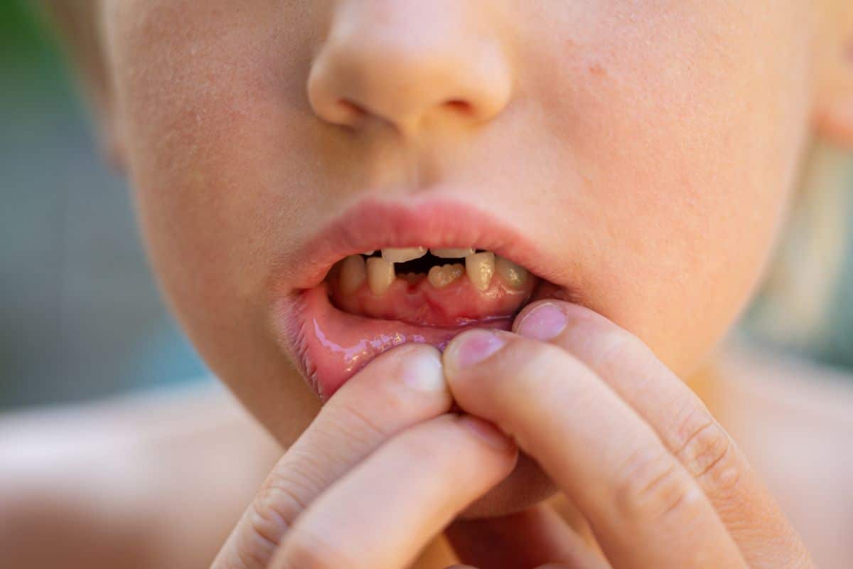 Why Are My Child’s Permanent Teeth Coming In Unevenly?